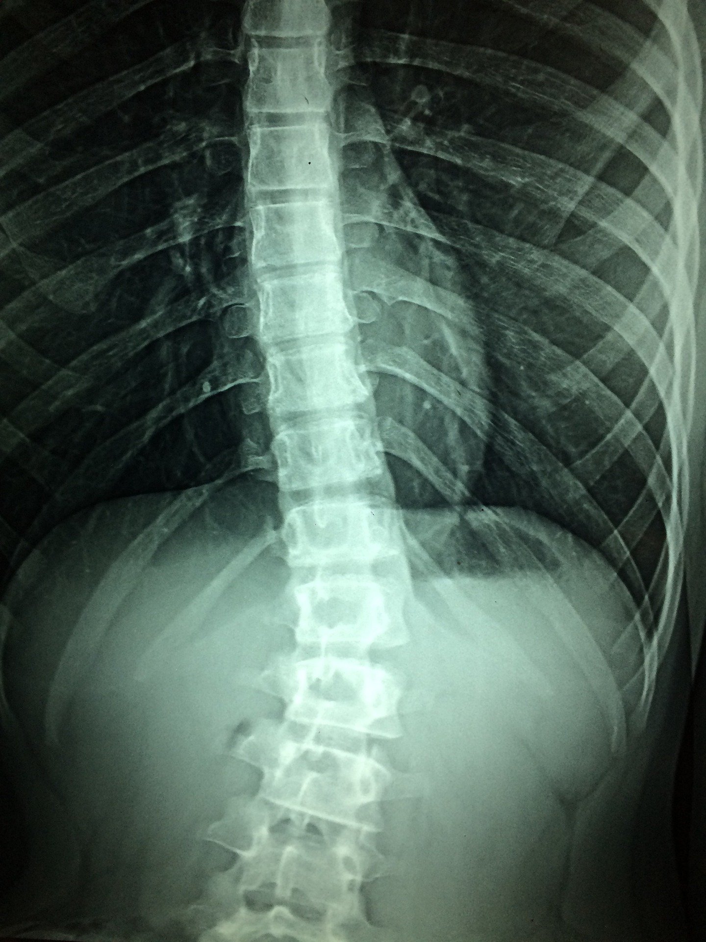 From Scientist to Innovators: improving the life of patients after spinal surgery